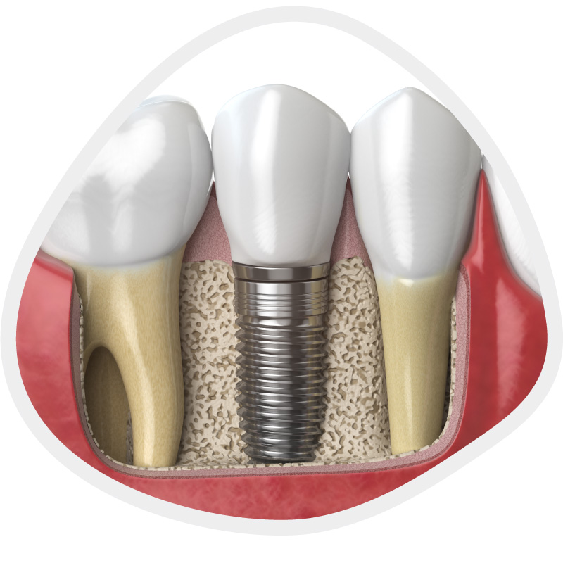 implant img1