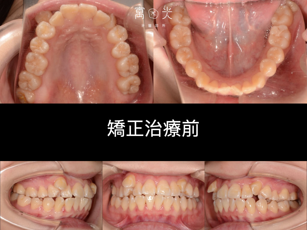 全口矯正案例-拔牙改唇形 1 case correction 1 1 1