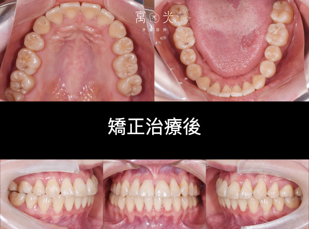 全口矯正案例-拔牙改唇形 2 case correction 1 2 1