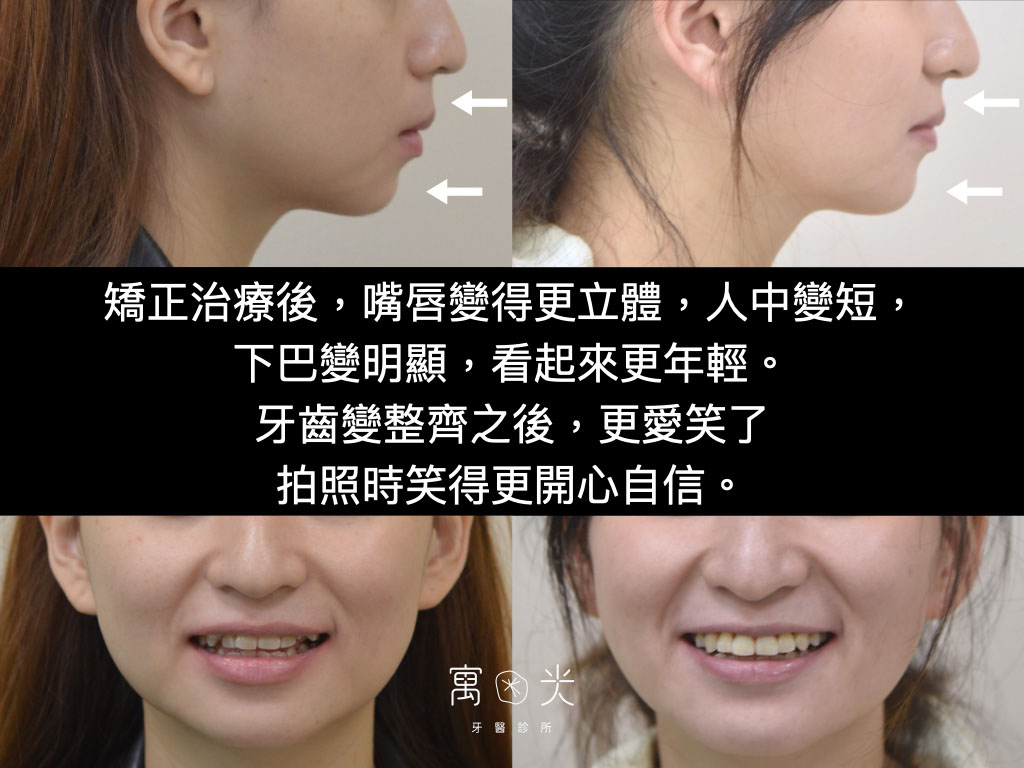 全口矯正案例-拔牙改唇形 3 case correction 1 3 1