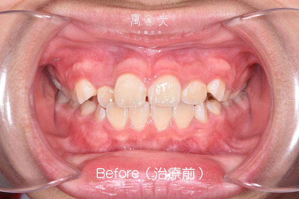 局部矯正案例 1 case correction 2 1 1