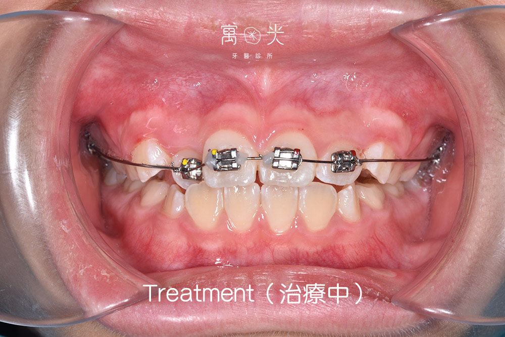 局部矯正案例 2 case correction 2 3 1
