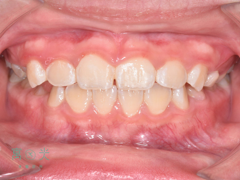 Read more about the article 局部矯正案例