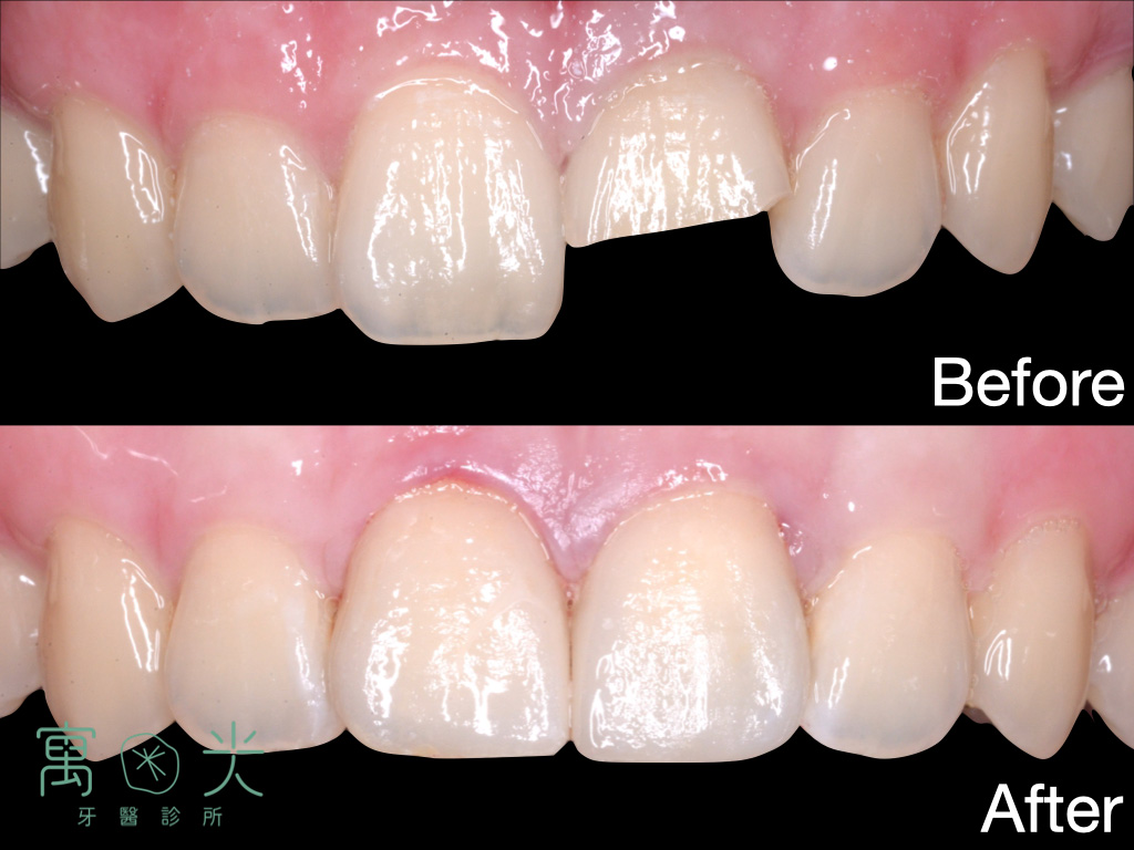 陶瓷貼片案例 1 case veneer 1 1